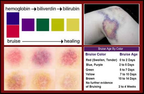 bruise cover up color chart.